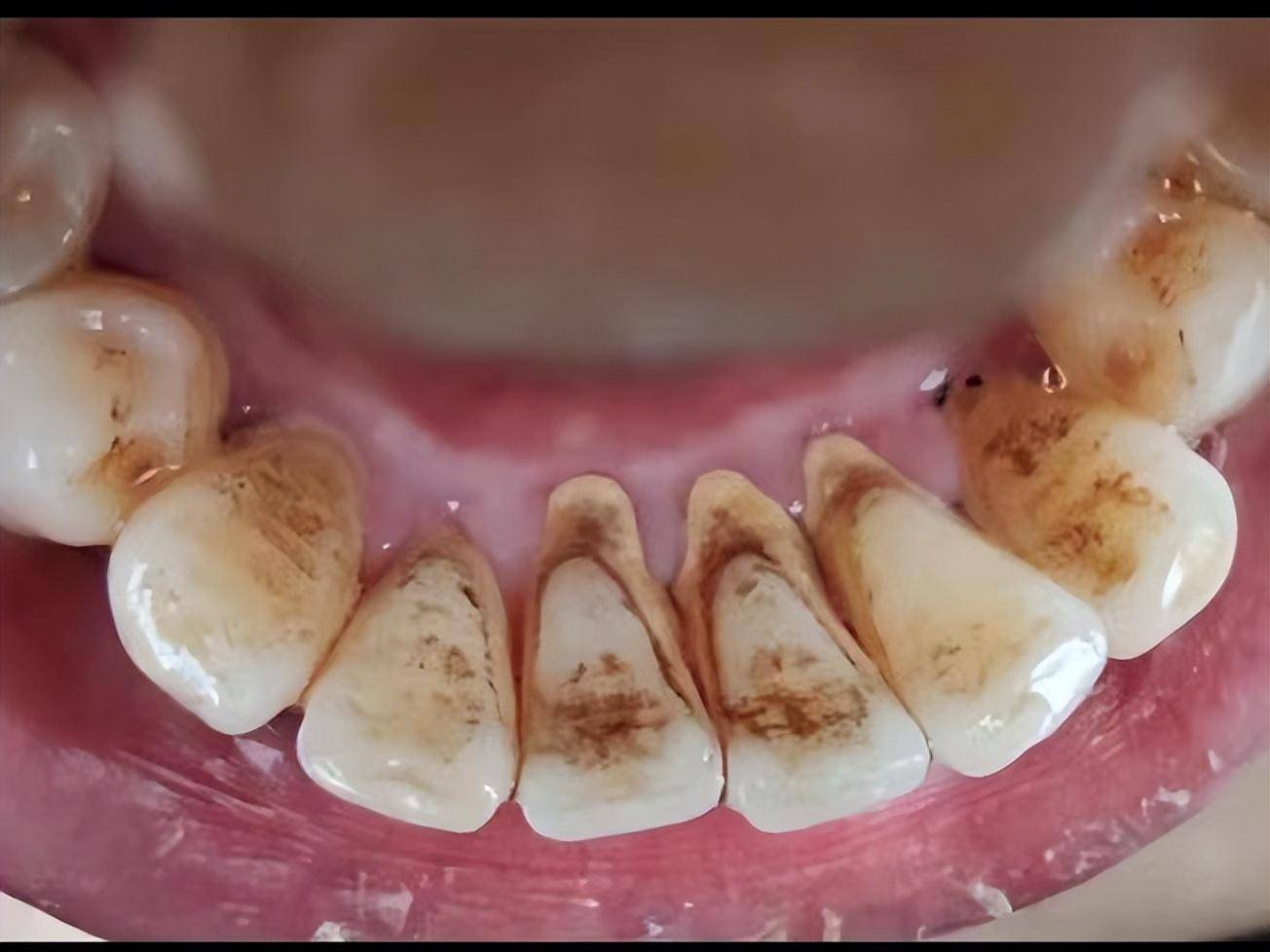 史上最有效的去除烟渍,牙渍的方法!用好一个,黄牙瞬间靓白!