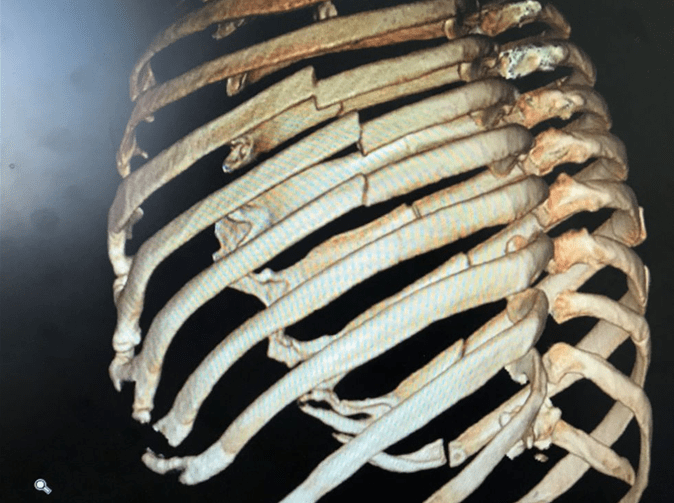 送到急诊检查发现,老汪的右侧1~10肋骨,左侧1~4肋全都骨折了,右侧颈部