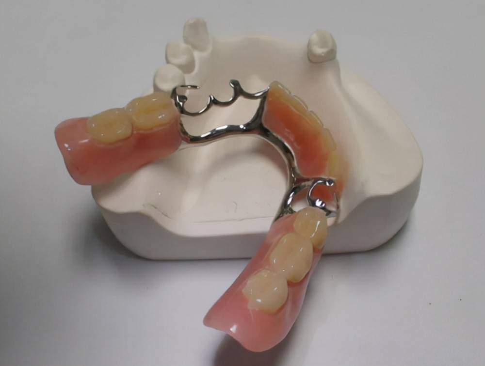 缺牙的四种修复方式,你都清楚了吗?