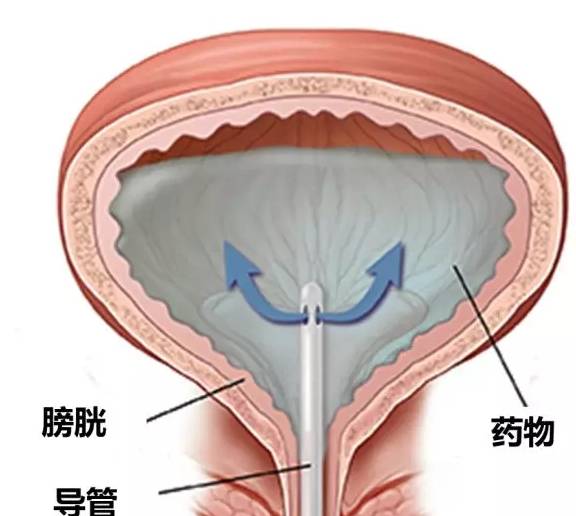 膀胱热灌注图片