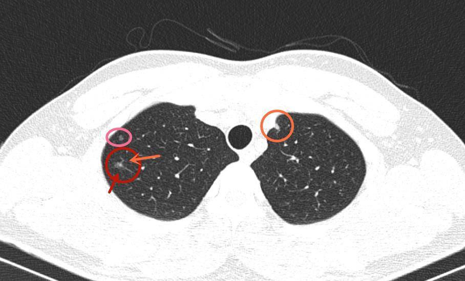 密度不均,中间有高密度;邻近区域有个小的伴小空泡的微小磨玻璃结节