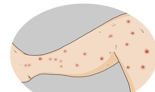 花粉,柳絮,紫外线等等,吃的方面常见的过敏原就是芒果,菠萝,茄子,菠菜