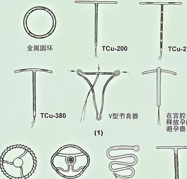 莫名消失在子宫,一只耐不住寂寞的节育环