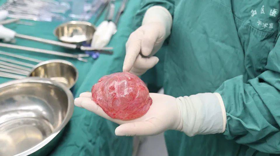 男子长巨型肺大泡 医生称与其30年吸烟史有关_肺泡_汪先生_治疗