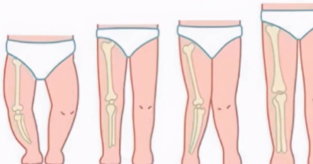儿童膝内外翻畸形_膝关节_下肢_股骨
