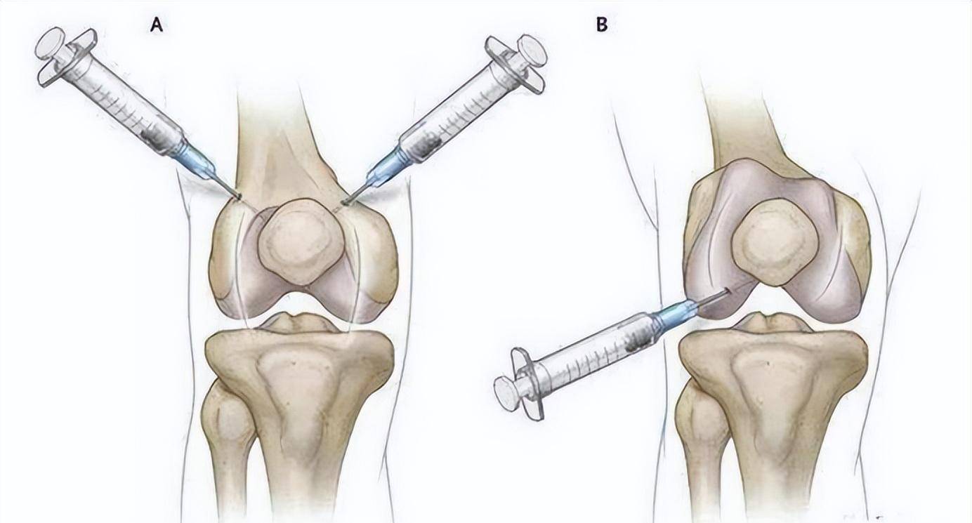 跟骨骨刺封闭注射位置图片