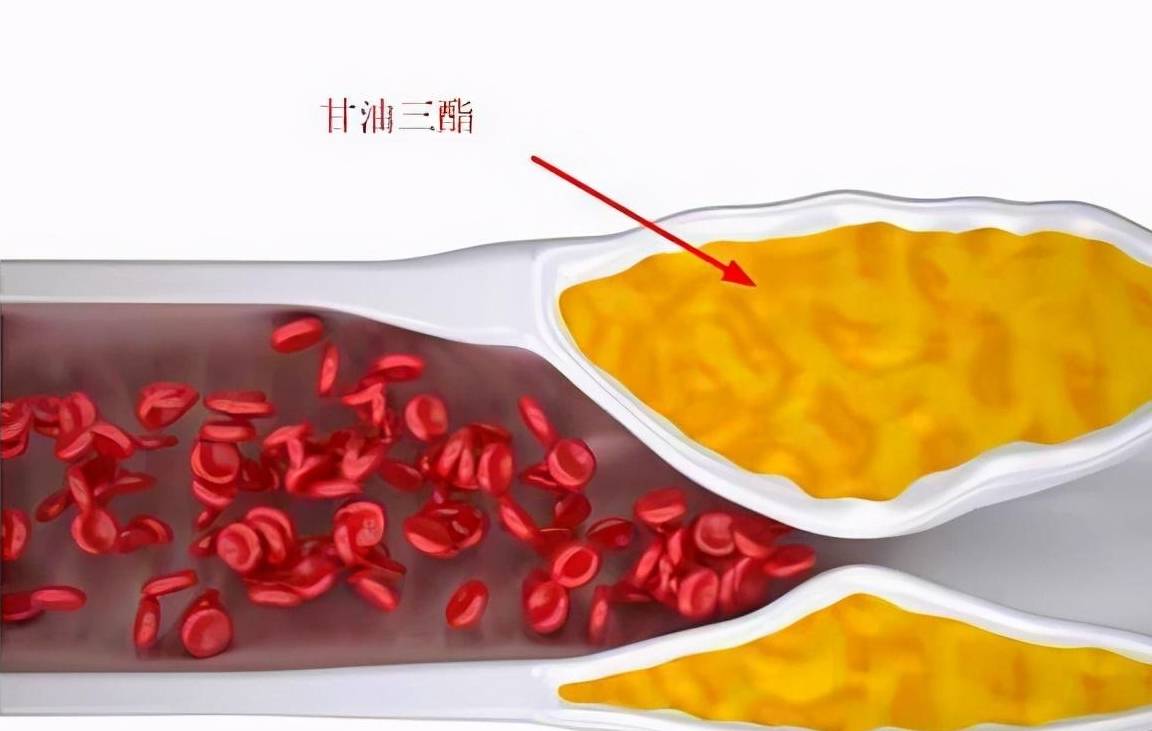 原创            甘油三酯高了就要吃药？医生：错了，达到一定的数值才要吃降脂药