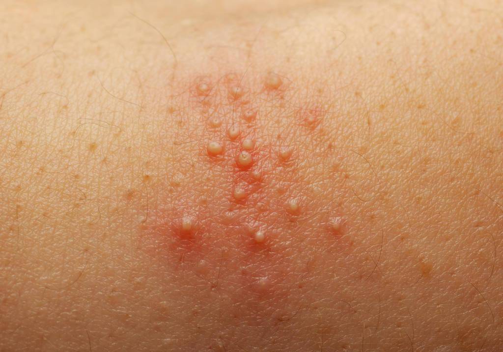瘙痒瘙痒是艾滋病的常见皮肤症状之一,通常出现在脚底,手掌,腿部等处