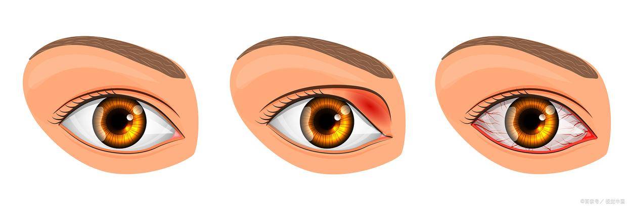 1.16来袭,引发结膜炎该如何应对?_眼睛_儿童_症状