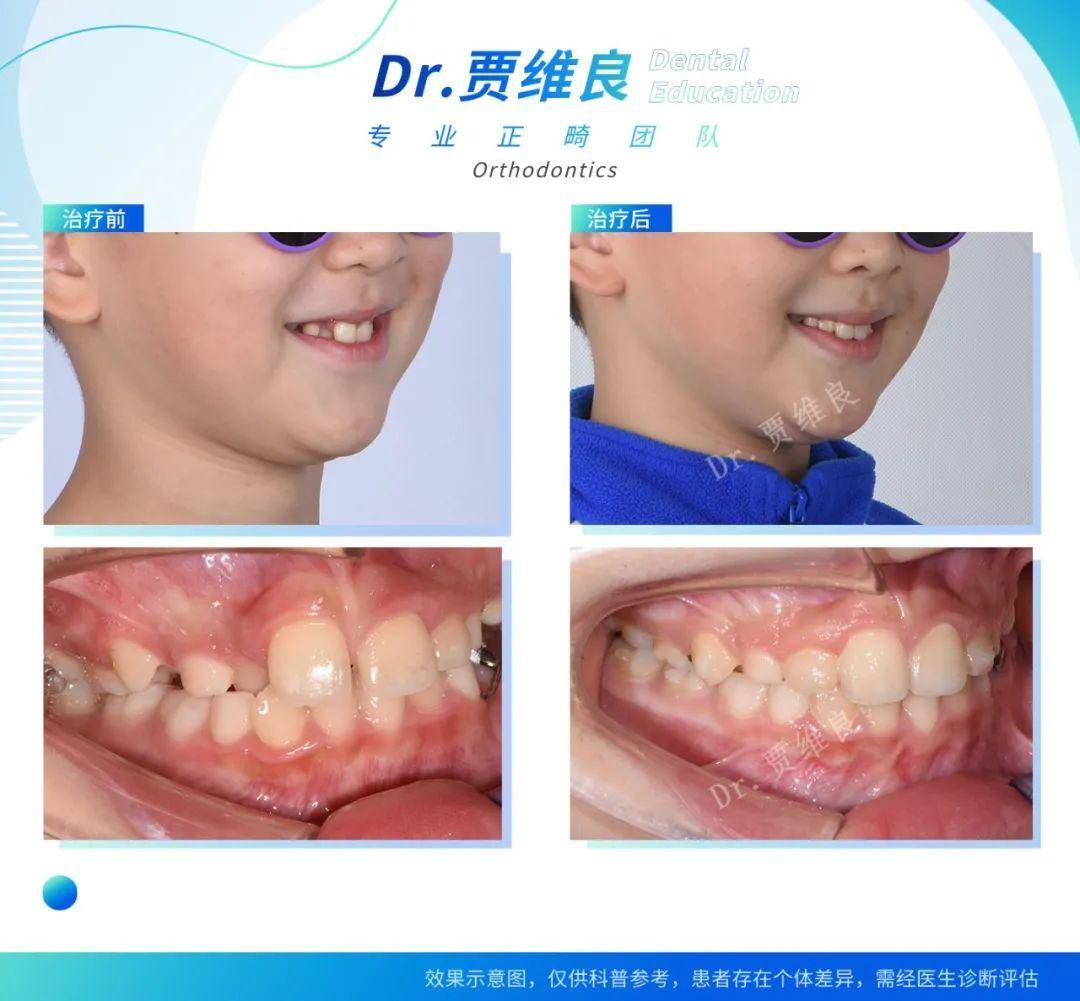 牙弓恢復正常卵圓形 側貌更好看dr.