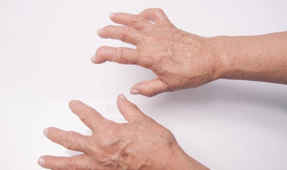 医生,我手指晨僵,疼痛,是不是类风湿关节炎?_症状_软骨_畸形