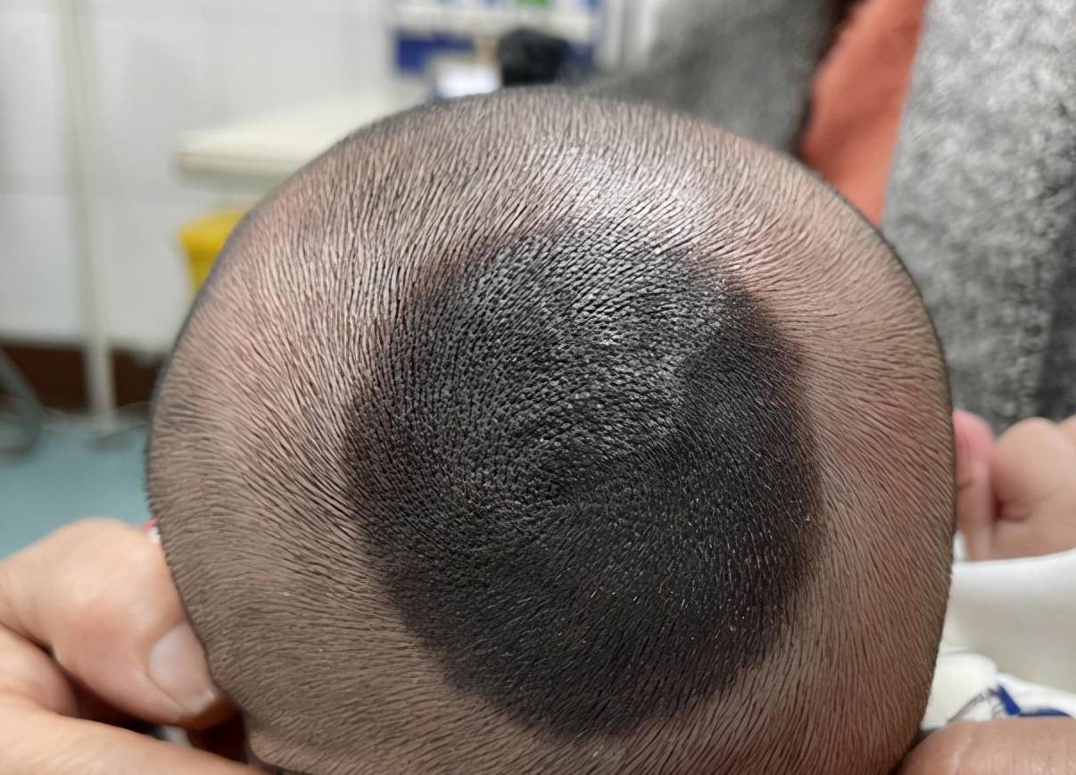 黑毛痣就很可能变成"恶"痣的一种,痣它局部发黑,表面粗糙不平甚至隆起