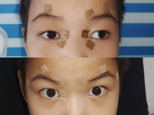 斜视眼手术最佳年龄和度数_斜视眼睛矫正手术多少钱_超眸国医堂治疗