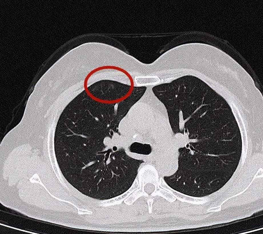 判斷肺混合磨玻璃結節不是癌,這一點很重要_病灶_密度_上圖