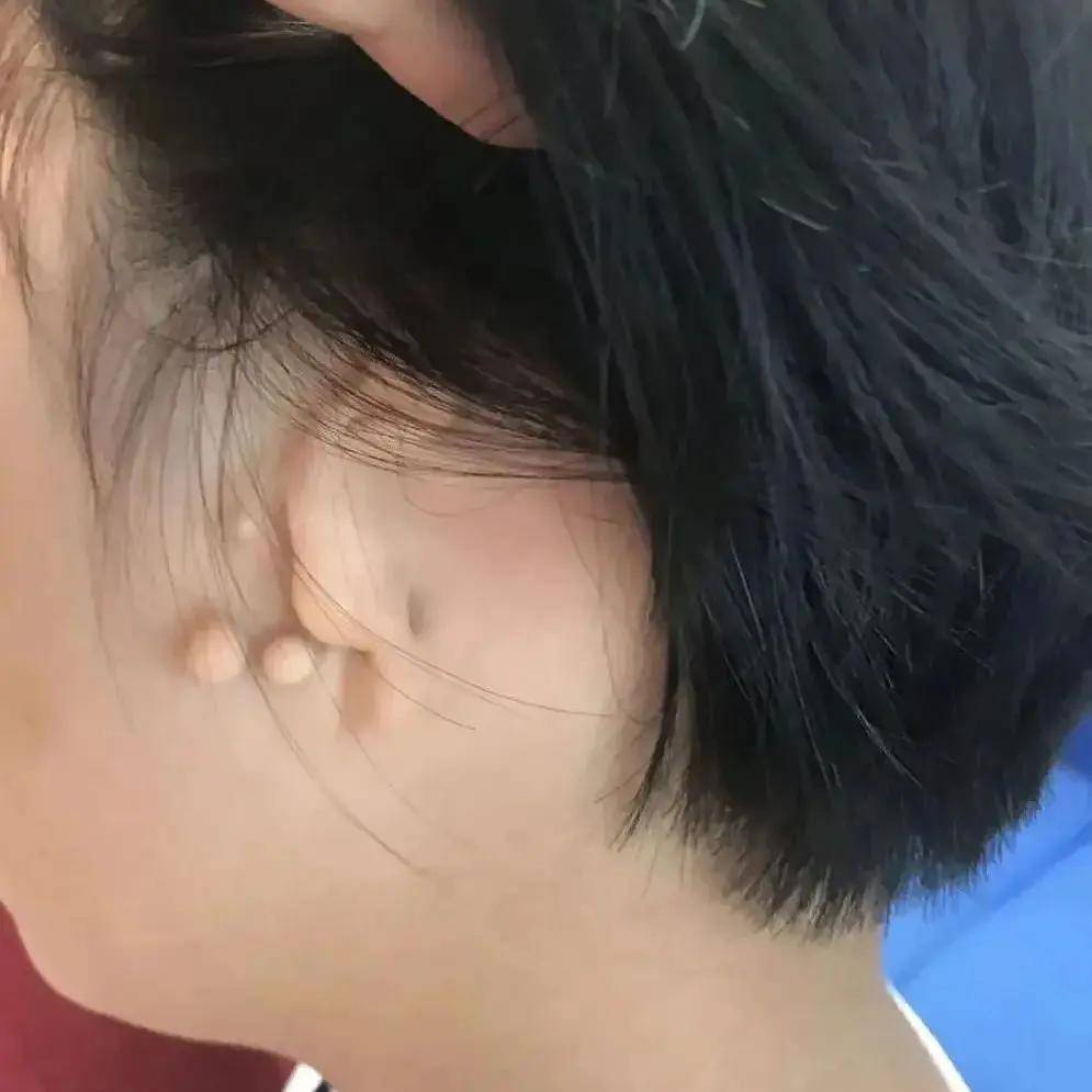 綦江惠耳助听器与您分享:双侧外耳道闭锁听力干预案例分享_进行_小耳