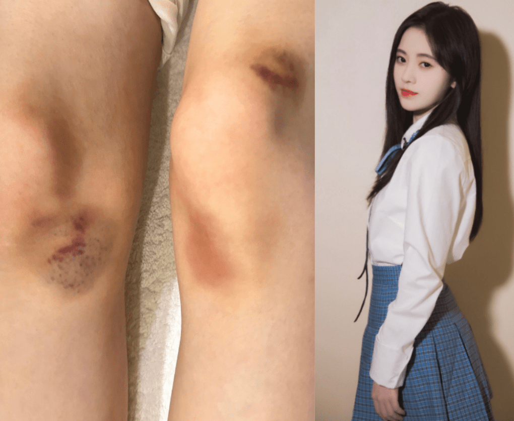 鞠婧祎晒膝盖受伤照,膝盖内侧多处淤青,透露自己打着多份工_舞蹈_工作