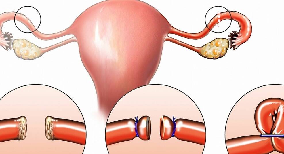 男人结扎了以后,会面临什么后果呢?终于可以放心了?_输精管_精子_上环