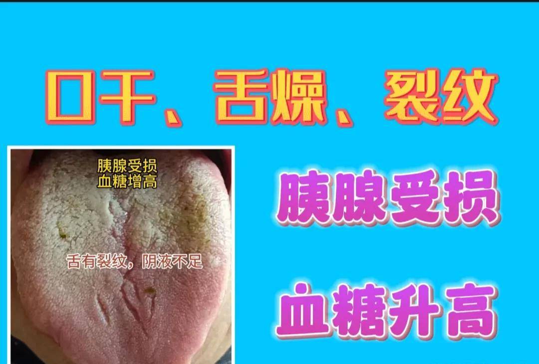 此舌象特点:舌苔薄腻,舌质红,裂纹舌,再根据本人的临床表现,就是:胰腺