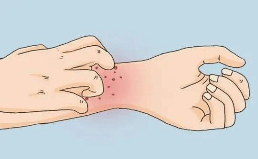 手癣和湿疹的区别_水疱_症状_发病