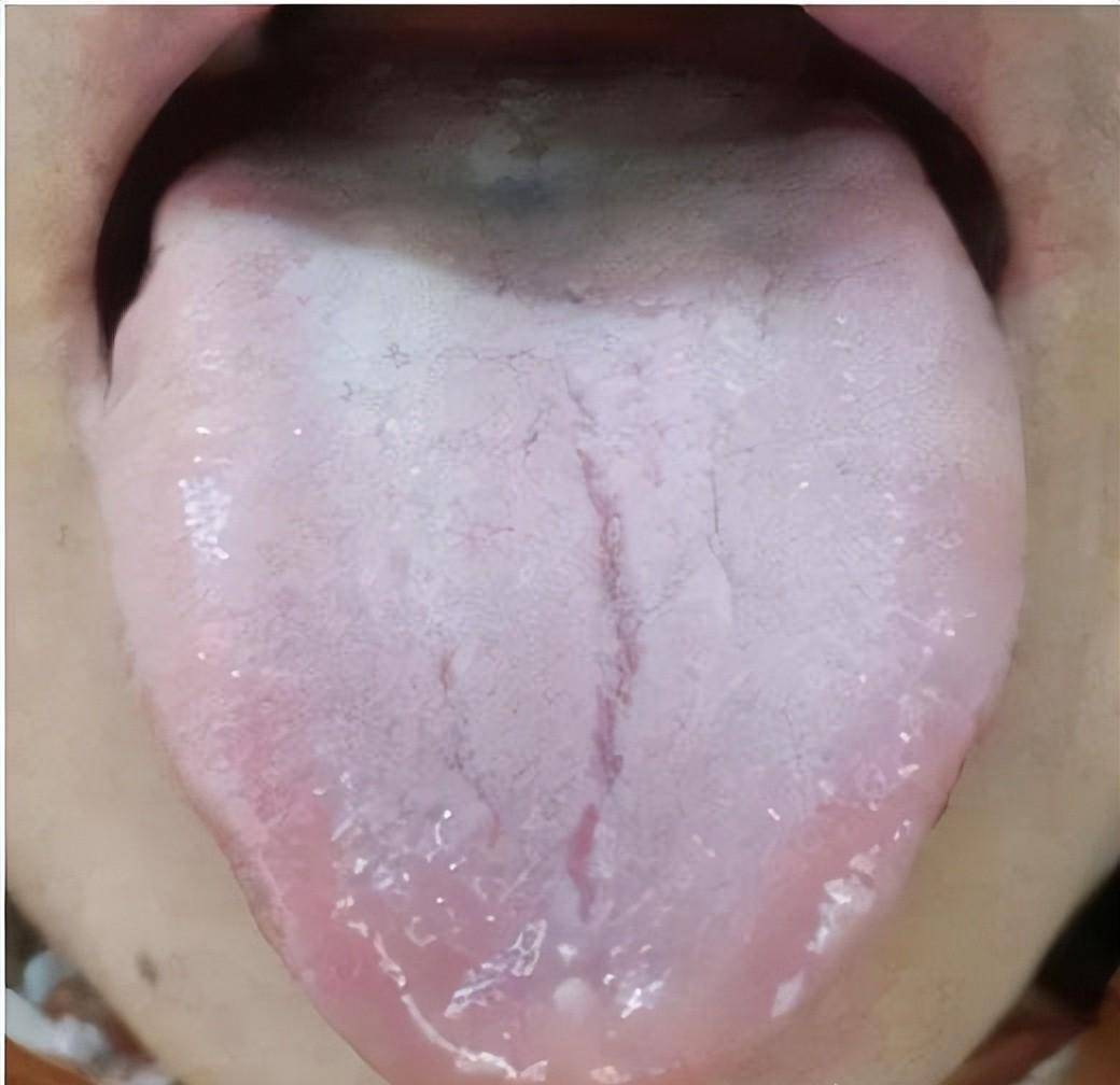 风痰上扰,肝风内动,脑窍被堵,故见眩晕头痛;痰浊中阻,清阳不升,浊气不