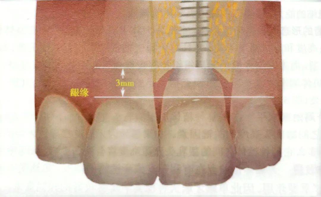 牙体长轴图片图片