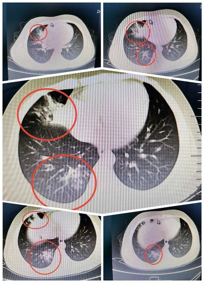 宝宝肺炎图片ct图片