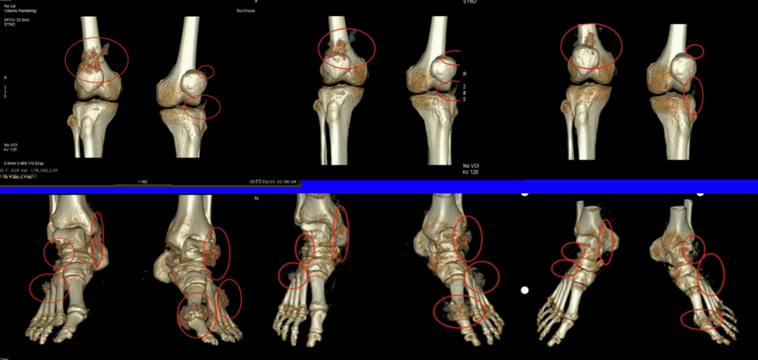 双源ct痛风图片分析图片