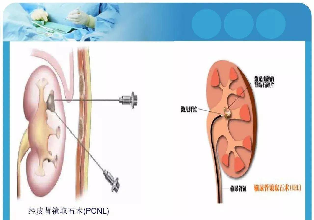 输尿管镜进镜技巧图片图片