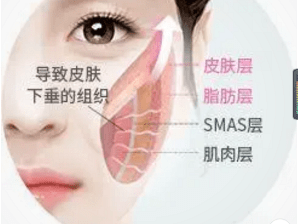 再问：面部筋膜提升术能保持多久？面部筋膜悬吊的术后恢复做的咋样？-筋膜悬吊术面部凹陷坑图片