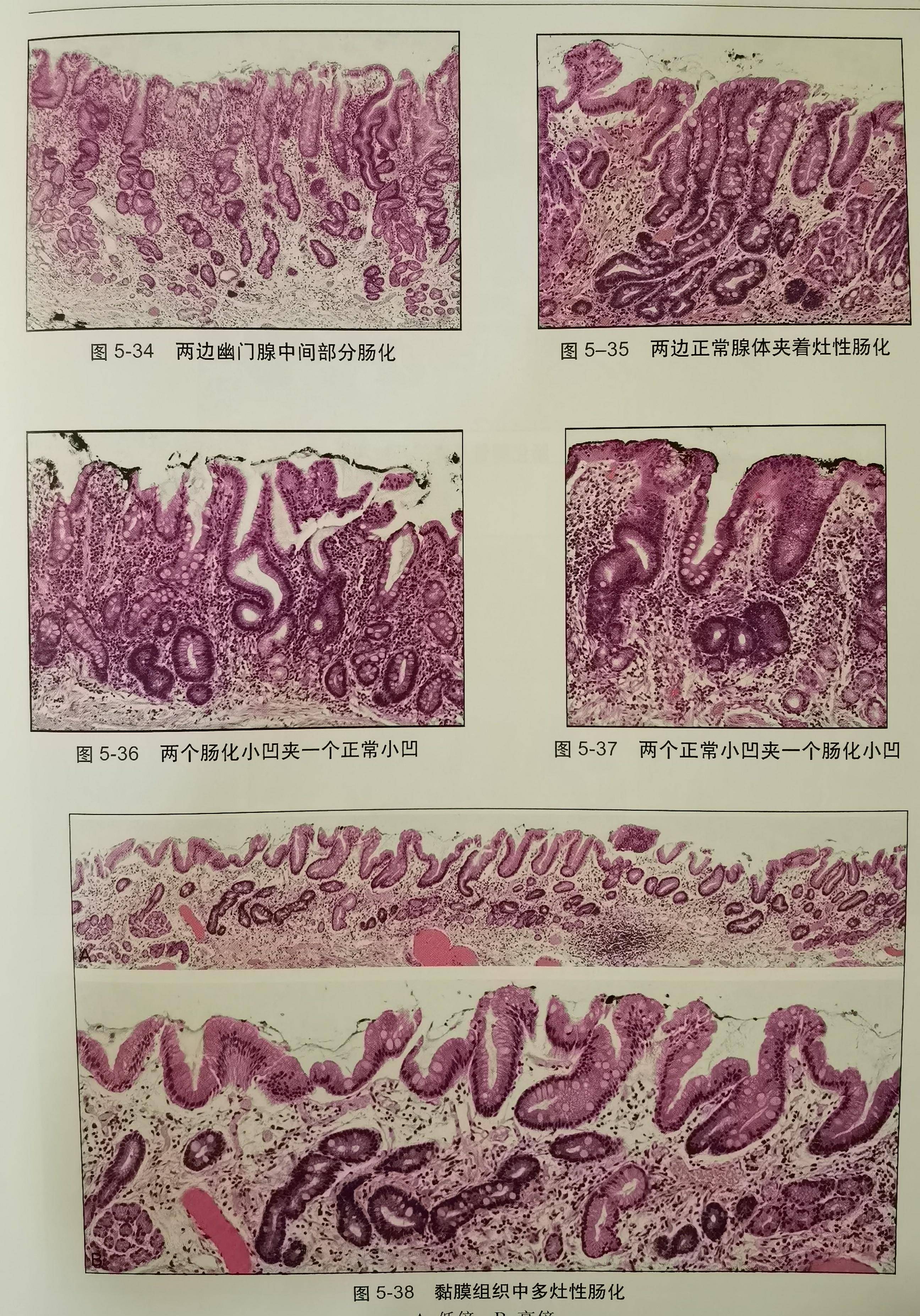 胃里的肠化不要怕