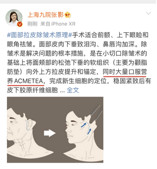 再问：面部筋膜提升术能保持多久？面部筋膜悬吊的术后恢复做的咋样？-筋膜悬吊术面部凹陷坑图片