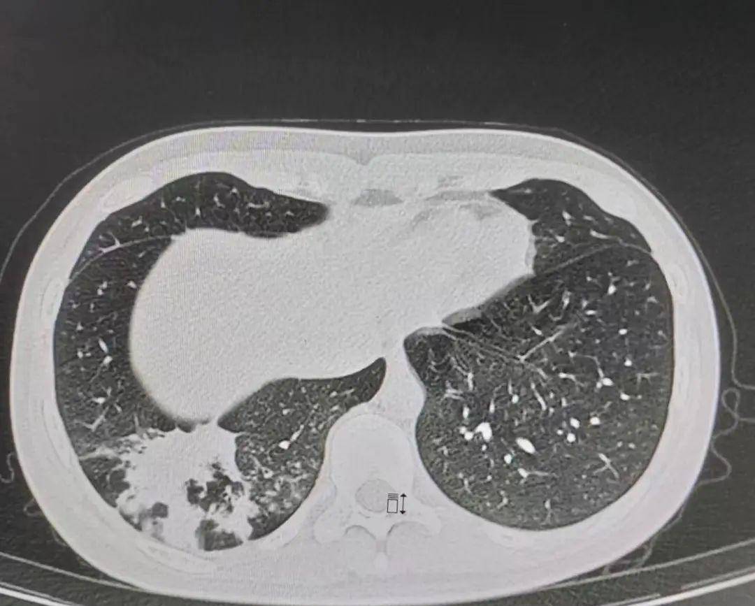 16岁少女确定支原体肺炎,症状迟迟未好转,抗菌药物该如何选择?