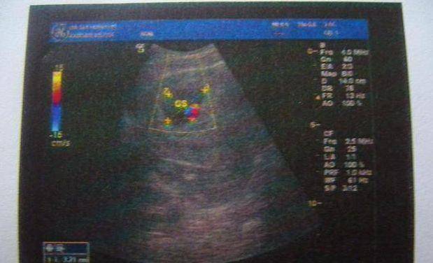 b超单信息含量大,这几个重要信息,关乎胎儿健康,你会看吗?