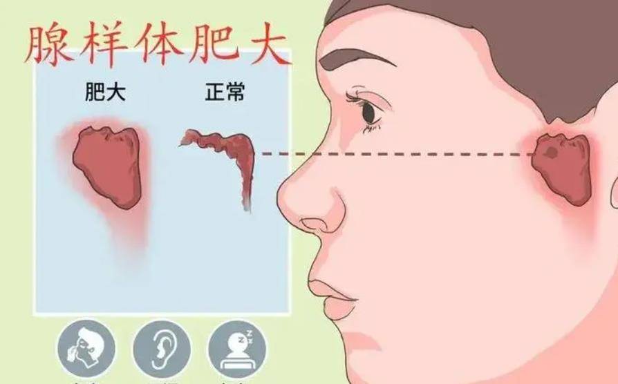 为医学发展添砖加瓦,探索分泌性中耳炎应用疗法有哪些?