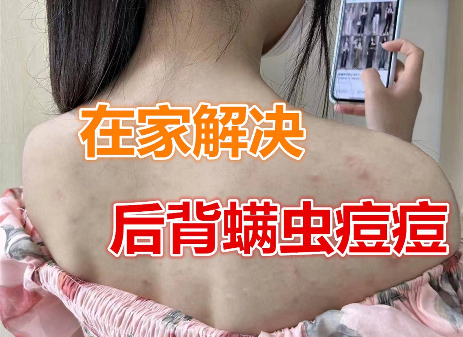 过来人的建议就是牛!居家洗洗后背秒光滑_皮肤_痘痘_效果