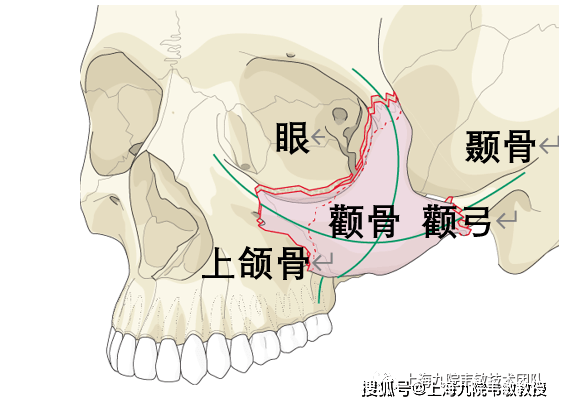 脸部颧弓颧骨位置图片图片