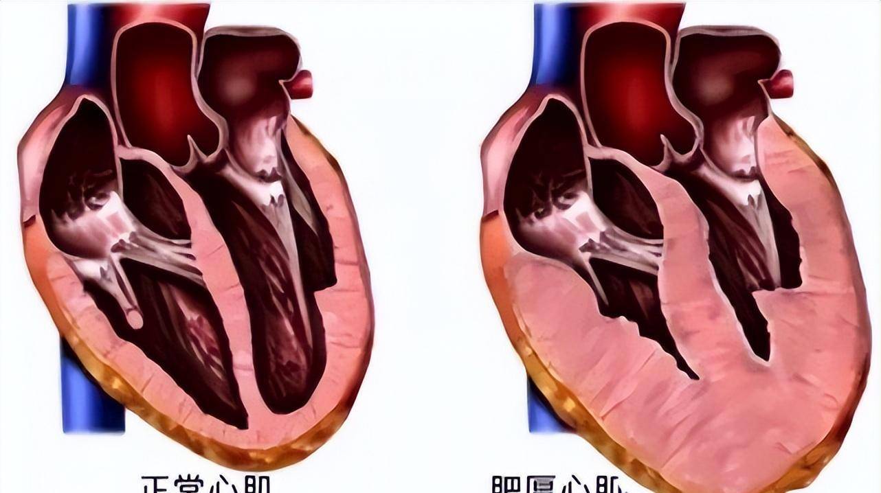 2,扩张型心肌病通过研究非缺血性扩张型心肌病(dilatedcardiomyopathy