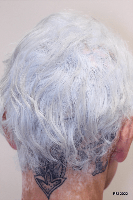 jaad|脱发患者头皮纹身后,头发竟完全再生!什么原理?