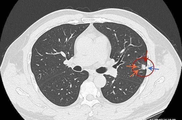 肺部实性结节图片图片