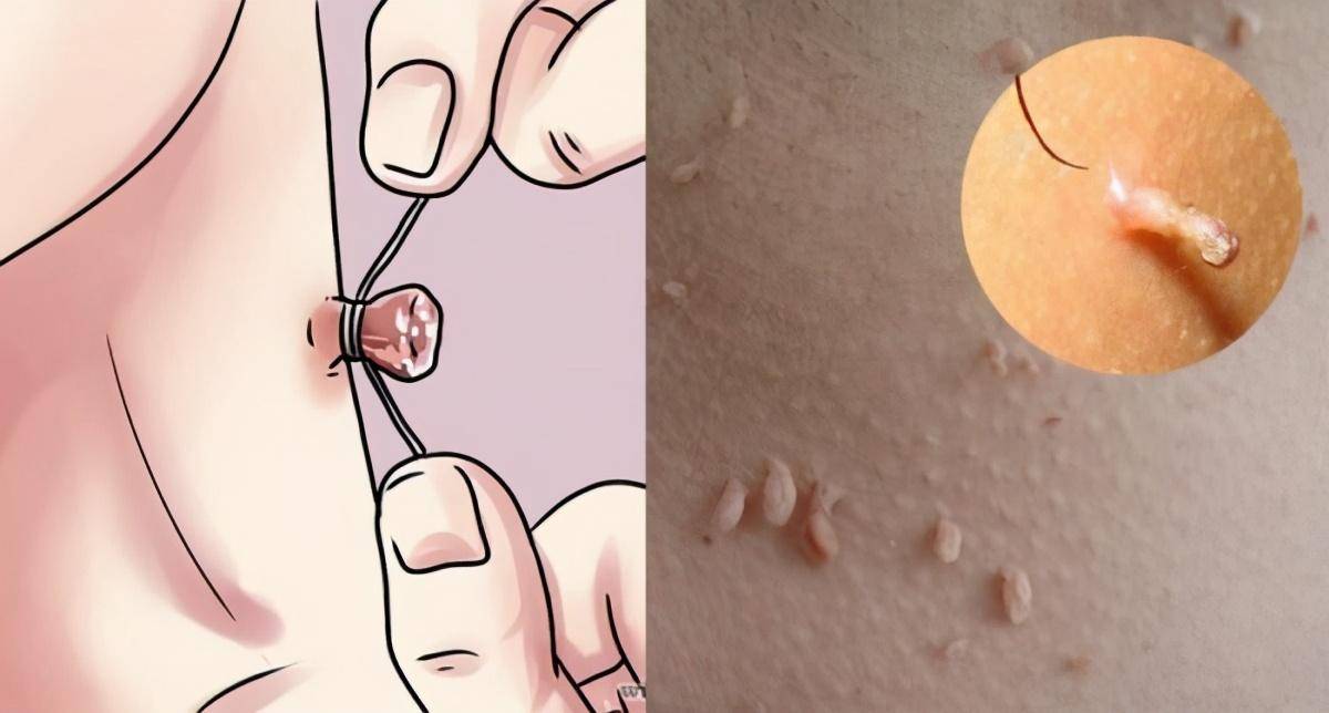 脖子和腋下的"小肉粒"是什么?能用手直接揪掉吗?别再忽视了_皮肤_身体