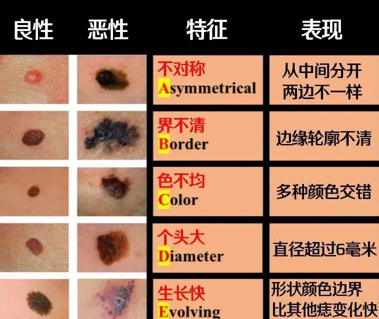 这样的"痣"要小心!_诊断_皮肤_治疗
