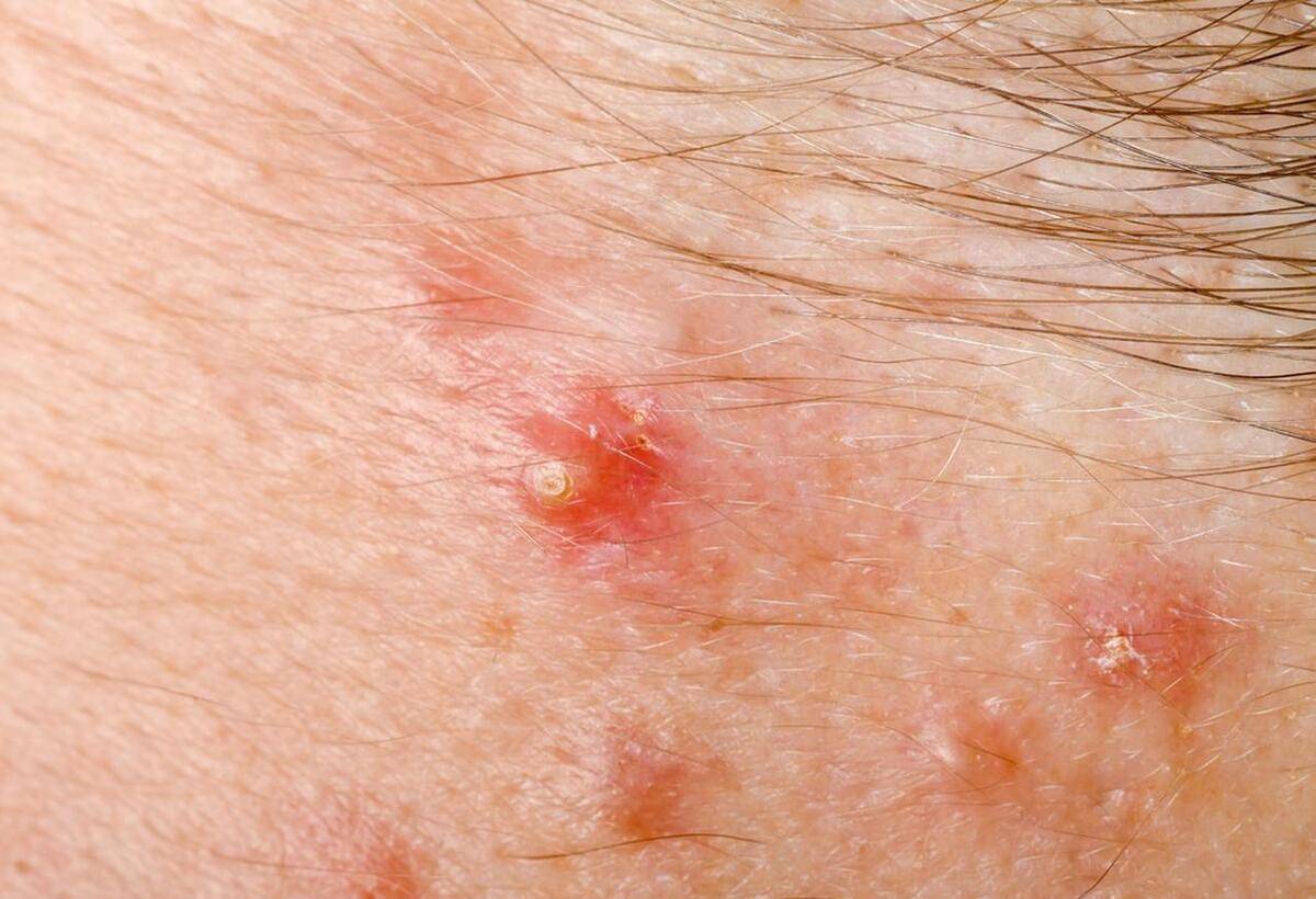 男性身上的白色丘疹通常是指阴茎或阴囊附近出现的小丘疹或斑点,通常