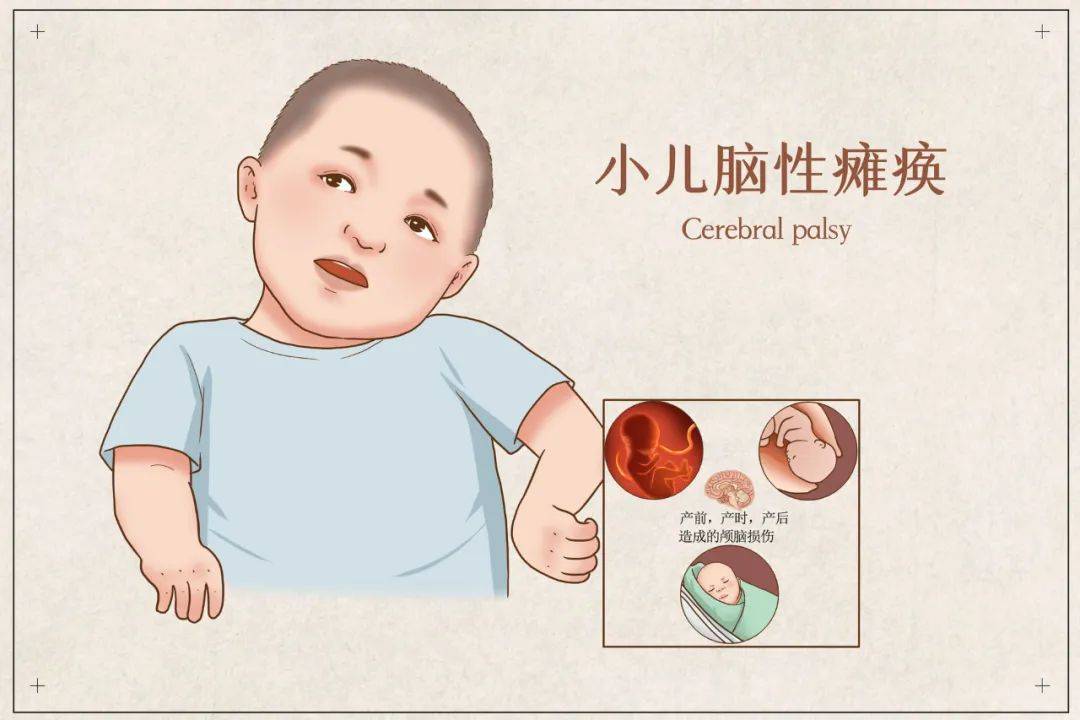 儿科医生王玲:【健康科普】小儿脑瘫的危害有哪些?如何治疗?