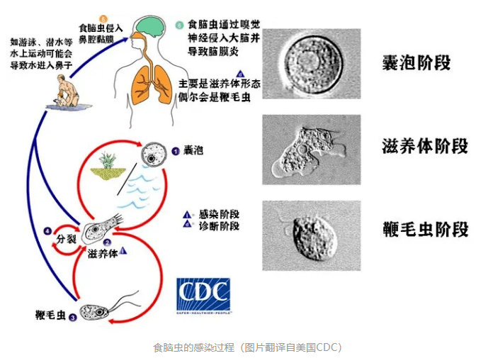 贵州6岁男童感染食脑虫,命悬一线_治疗_孩子_阿米巴