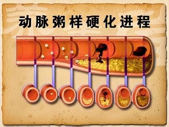 治疗动脉硬化最好的医院_血管_泉州_患者