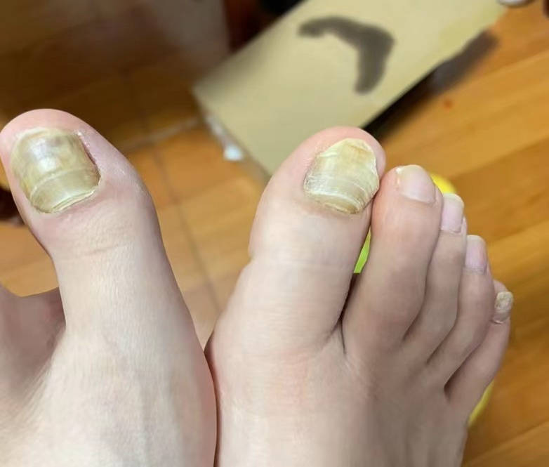 5年灰指甲终于痊愈!过来人教你一招不吃药不拔甲!38天轻松亮甲!