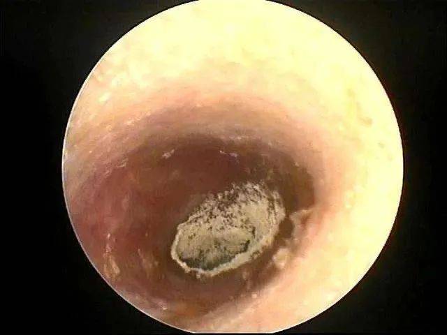 成都民生耳鼻喉医院:耳朵又疼又痒当心真菌性外耳道炎找上门 国家三级
