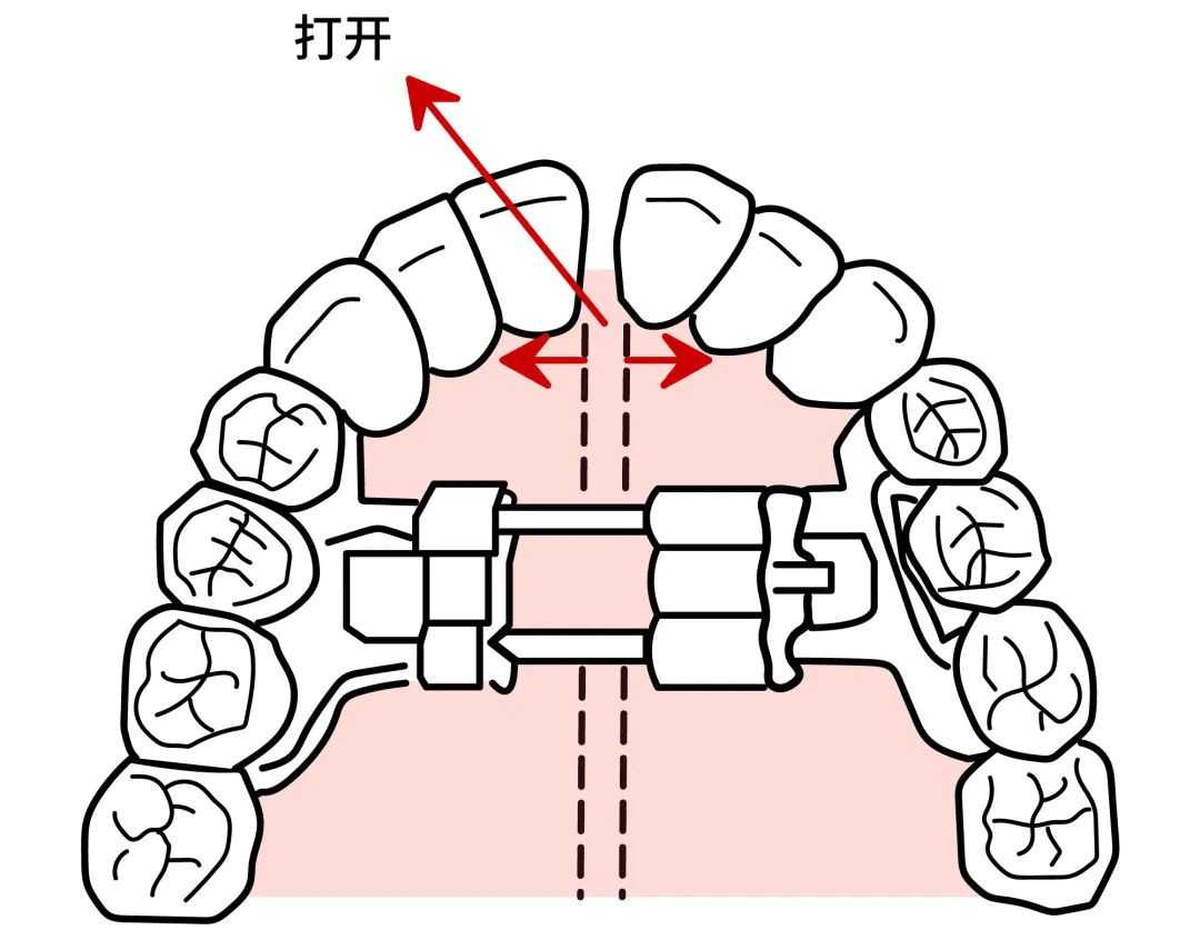 腭中缝图片