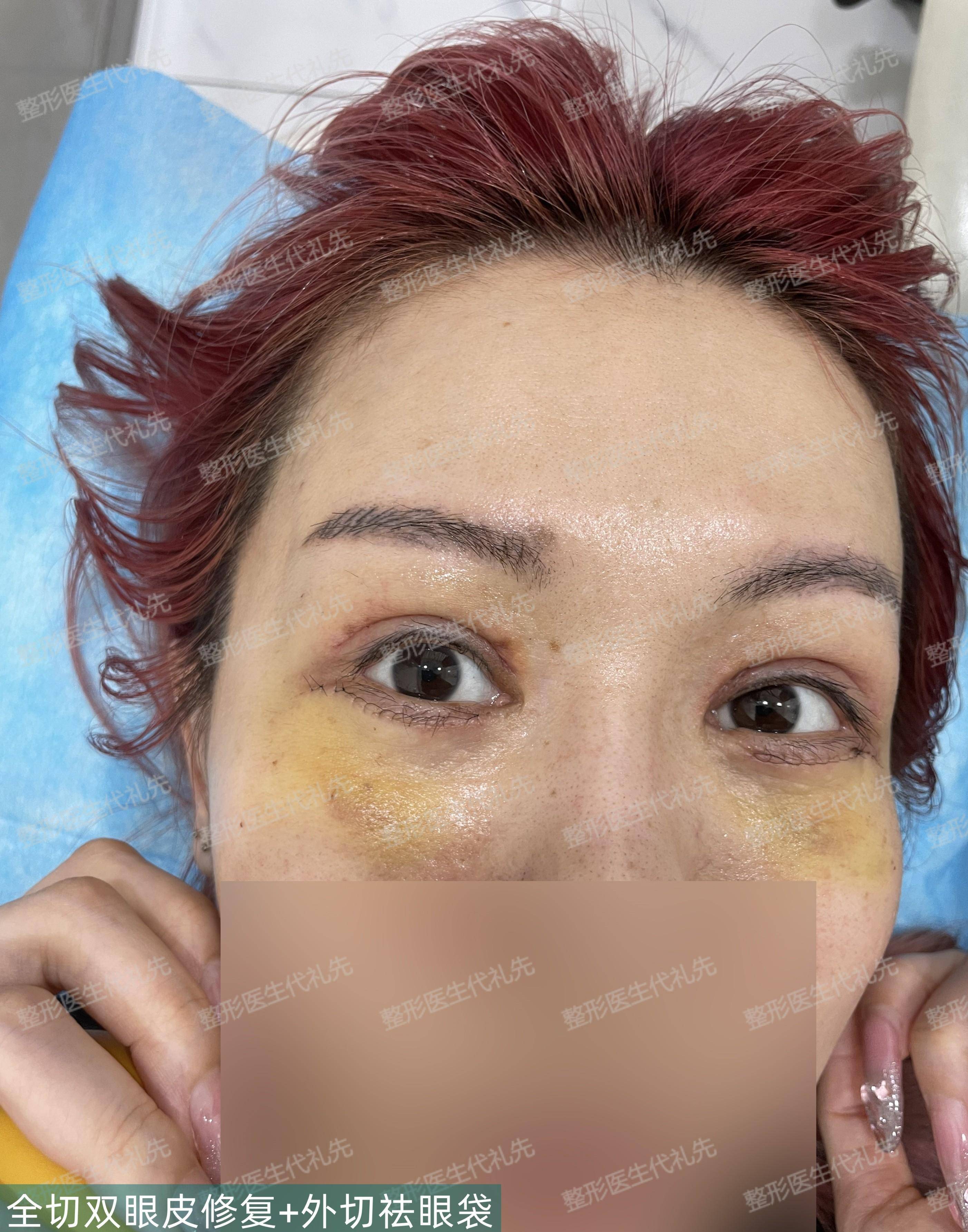 49岁女士来做了全切双眼皮 外切眼袋 眼窝凹陷填充,术后7天拆线_手术