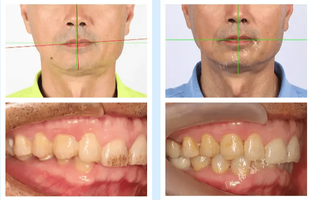 脸歪,不对称 杨敏志主任儿童青少年及成人偏颌矫正_咬合_牙齿_关节
